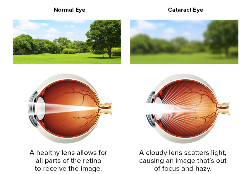 CATARACTS Falgoust Eye Medical Surgical