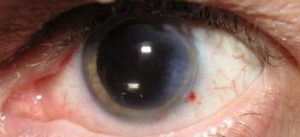 Cataract in eye Exam at Falgoust Eye Medical & Surgical in Lake Charles